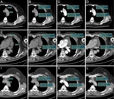 Thymic cyst: Is attenuation artifactually increased on contrast-enhanced CT?